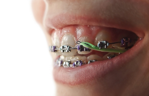 Learn More About Why Elastics Are Needed for Orthodontic Patients